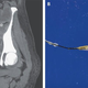 The left image is a CT scan taken of the patient, with the arrow pointing to her IUD and the asterisk denoting an nearby abscess. The right image is of the IUD after removal, with the yellow substance thought to be the bacteria that caused her infection.